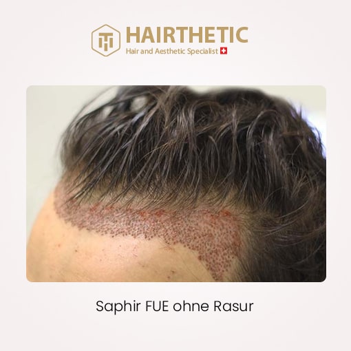 Haartransplantation Ohne Rasur-vorher nachher bilder-erfahrungsberichte-Beste Haarklinik Schweiz Hairthetic (2)-min