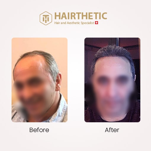 Haatransplantation Schweiz - Vorher Nachher Bild - Erfahrungsberichte - Beste Haartransplantation Klinik Schweiz Hairthetic (1)-min