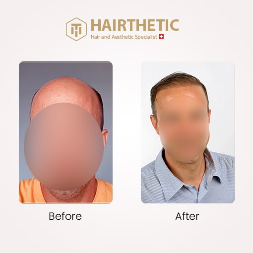 Haatransplantation Schweiz - Vorher Nachher Bild - Erfahrungsberichte - Beste Haartransplantation Klinik Schweiz Hairthetic (3)-min