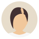 Kosten bei Haartransplantation-für Frauen-Beste Haarklinik Schweiz-Hairthetic-Ecken-Tonsur-min
