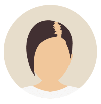 Kosten bei Haartransplantation-für Frauen-Beste Haarklinik Schweiz-Hairthetic-Ecken-Tonsur-min