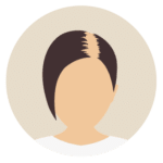 Kosten bei Haartransplantation für Frauen-Beste Haarklinik Schweiz-Hairthetic-Oberkopf Klein-min