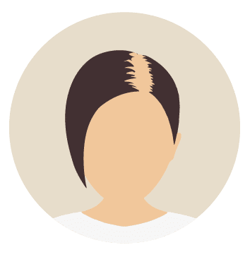 Kosten bei Haartransplantation für Frauen-Beste Haarklinik Schweiz-Hairthetic-Oberkopf Klein-min