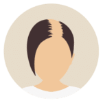 Kosten bei Haartransplantation für Frauen-Beste Haarklinik Schweiz-Hairthetic-Oberkopf Komplett-min
