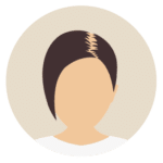 Kosten bei Haartransplantation für Frauen-Beste Haarklinik Schweiz-Hairthetic-Verdichtung-min