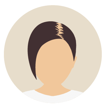Kosten bei Haartransplantation für Frauen-Beste Haarklinik Schweiz-Hairthetic-Verdichtung-min