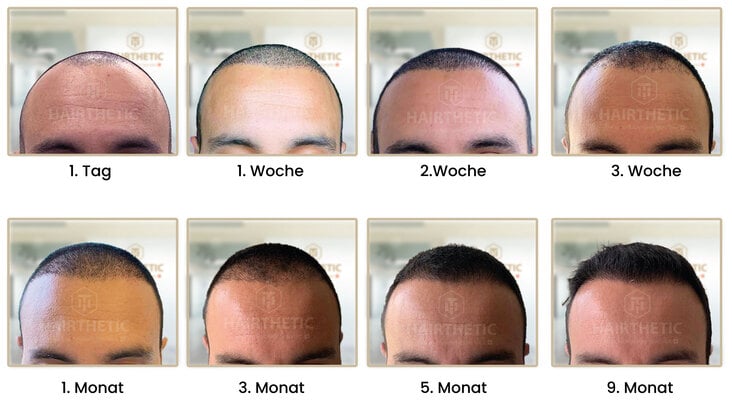 Haartarnsplantation-Schweiz-Vorher-Nachher-Erfahrungen-Hairthetic-Beste Haarklinik Schweiz-m