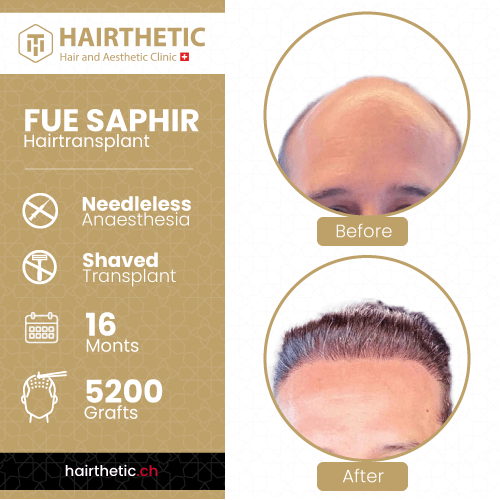 Haartransplantation Schweiz Zürich bei Hairthetic - Vorher Nachher bilder-Saphir haartransplantation ohne rasur-nadellos (11)-min