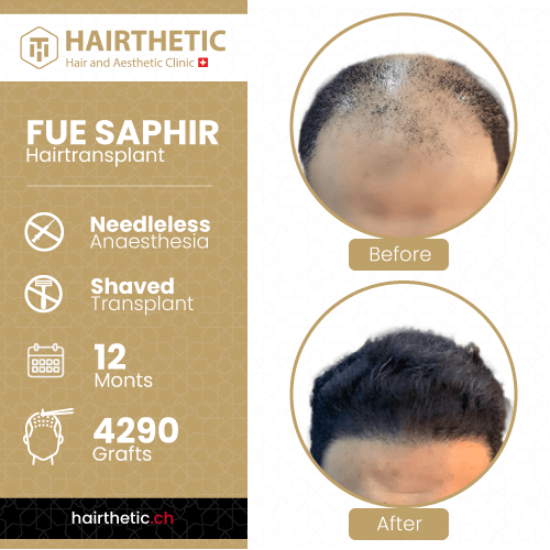 Haartransplantation Schweiz Zürich bei Hairthetic - Vorher Nachher bilder-Saphir haartransplantation ohne rasur-nadellos (2)-min