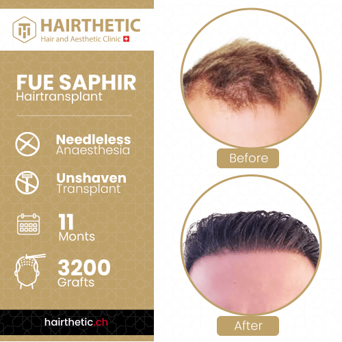 Haartransplantation Schweiz Zürich bei Hairthetic - Vorher Nachher bilder-Saphir haartransplantation ohne rasur-nadellos (4)-min