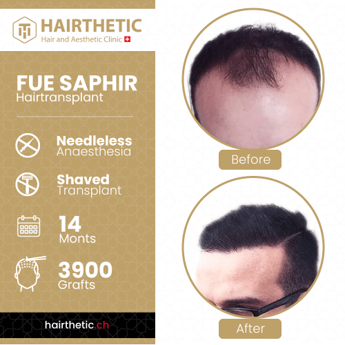 Haartransplantation Schweiz Zürich bei Hairthetic - Vorher Nachher bilder-Saphir haartransplantation ohne rasur-nadellos (6)-min
