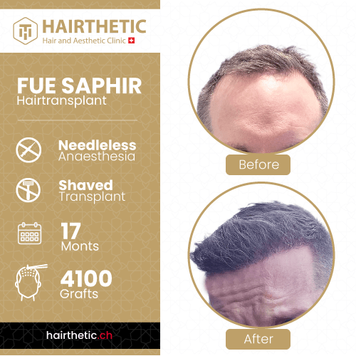 Haartransplantation Schweiz Zürich bei Hairthetic - Vorher Nachher bilder-Saphir haartransplantation ohne rasur-nadellos (7)-min