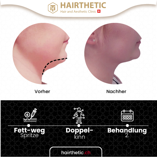 Fettwegspritze Injektions-Lipolyse Zürich Schweiz - vorher nachher bilder - beste klinik schweiz hairthetic (14)