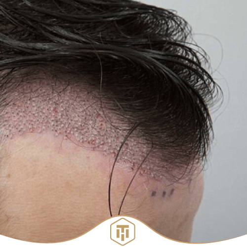 Saphir Haartransplantation ohne Rasur mit Nadellose Betäubung - Beste Haar Klinik Schweiz Zürich Hairthetic