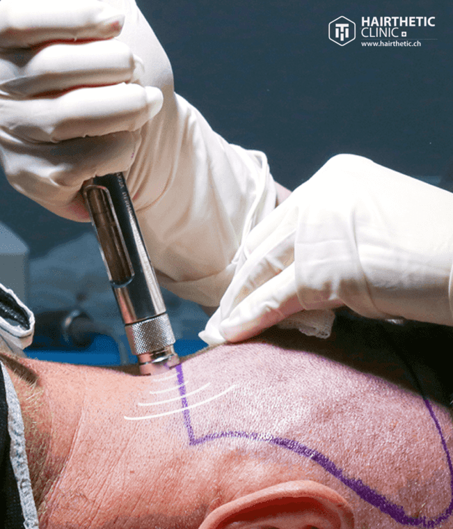 Nadellosse Haartransplantation - Needlefree Hairtransplant Schweitzerland Schweiz Zürich - Hairthetic Med Of Swiss