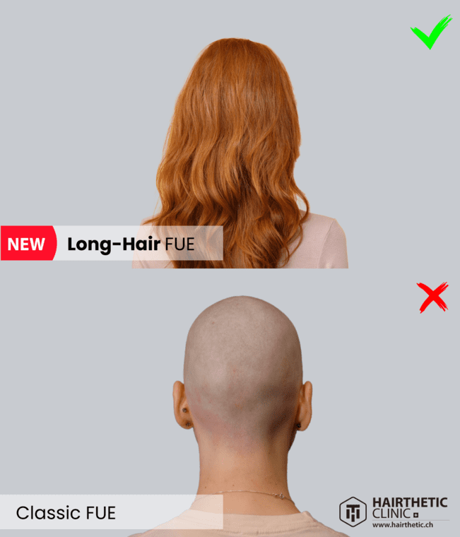Vergleich Frauen - Lange Haartransplantation - Long Hair Transplant Switzerland Beste Hair Clinic Hairthetic (3)