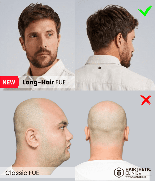 Vergleich - Man - Lange Haartransplantation - Long Hair Transplant Switzerland Beste Hair Clinic Hairthetic (2)