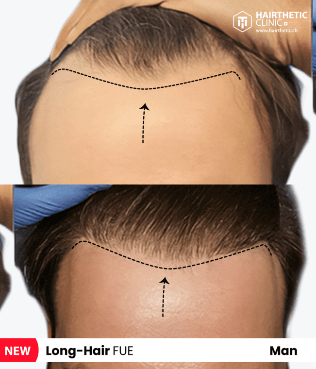 Vorher nachher Man 1 Lange Haartransplantation Long Hair Transplant Switzerland Beste Hair Clinic Hairthetic 6