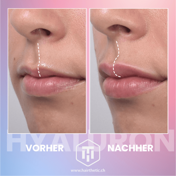 Hyaluron behandlung Lippen - vorher nachher -hairthetic klinik zürich - beste schönheitsklinik schweiz (3)-min