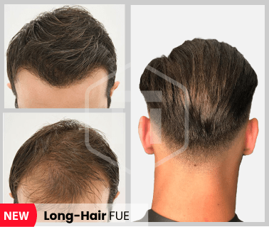 Long hair Haartransplantation Hairthetic Schweiz - Zürich - Beste Klinik-min
