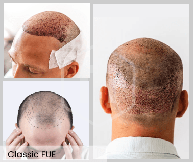 Saphir Fue Haartransplantation mit Rasur Hairthetic Schweiz - Zürich - Beste Klinik-min