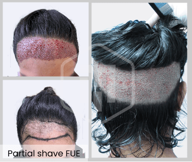 Saphir Fue Haartransplantation mit Teil rasur - Hairthetic Schweiz - Zürich - Beste Klinik-min