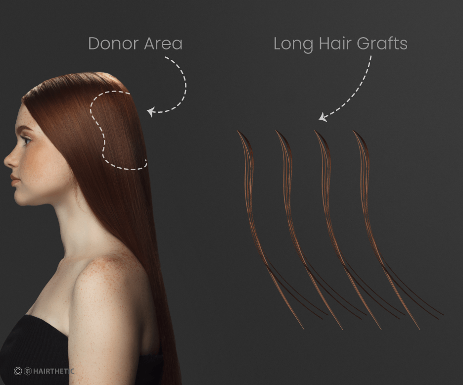 Long Hair Transplant - Lang Haar-Transplantation - Ablauf-Hairthetic Schweiz Beste Klinik (1)